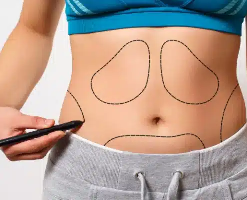 هزینه لیپوماتیک شکم وپهلو