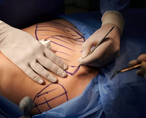 جراحی ابدومینوپلاستی