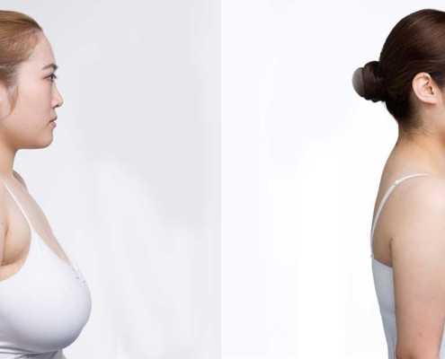 جراحی کوچک کردن سینه زنان