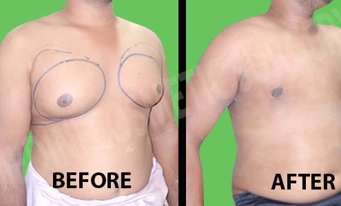 هزینه عمل ژنیکوماستی